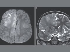 Esta é a aparência de um cérebro destruído pelo sarampo