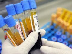 Simples exame de sangue pode prever demência com 25 anos de antecedência, sugere estudo