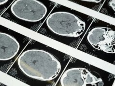 A corrida tecnológica do cérebro por ultrassom na China esquenta