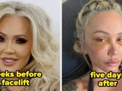 16 celebridades que admitiram fazer facelifts (e como estão agora)