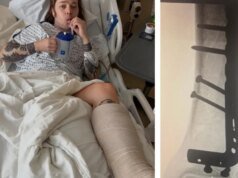 Billy Strings quebra a perna em dois lugares enquanto andava de skate durante o intervalo do encore: ‘Eu ouvi isso estalar sobre a multidão gritando!’