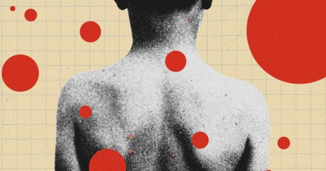 Shingles-Series-Chickenpox-Parties-Science.jpg