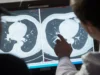 Médicos aclamam injeção contra câncer que pode destruir tumores inteiros